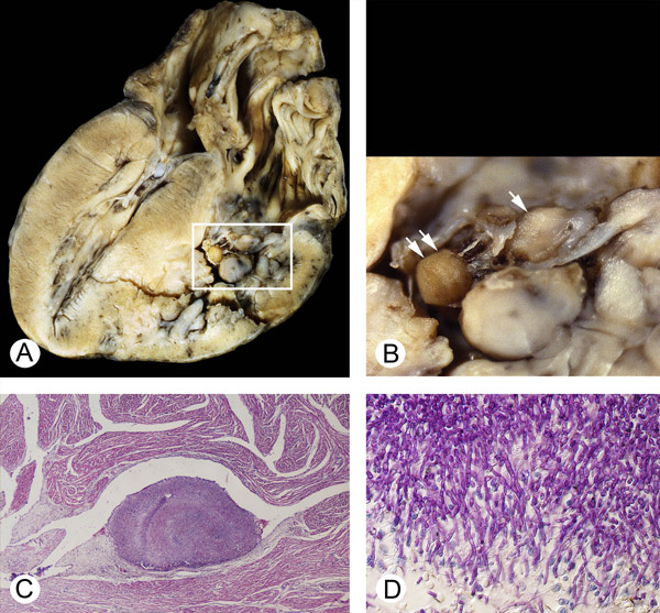 candida mural endocarditis